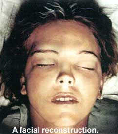 A facial reconstruction
